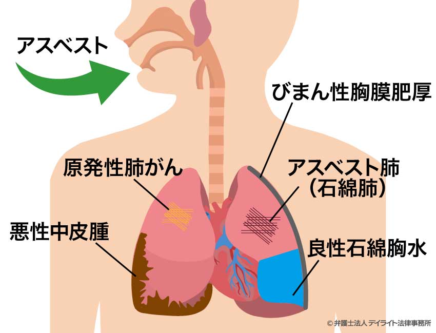 胸膜プラークとは？