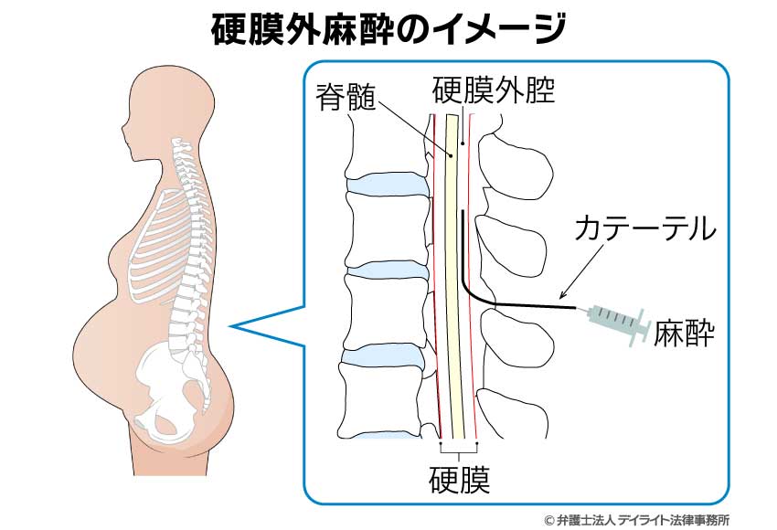 無痛分娩に使用される硬膜外麻酔のイメージ図